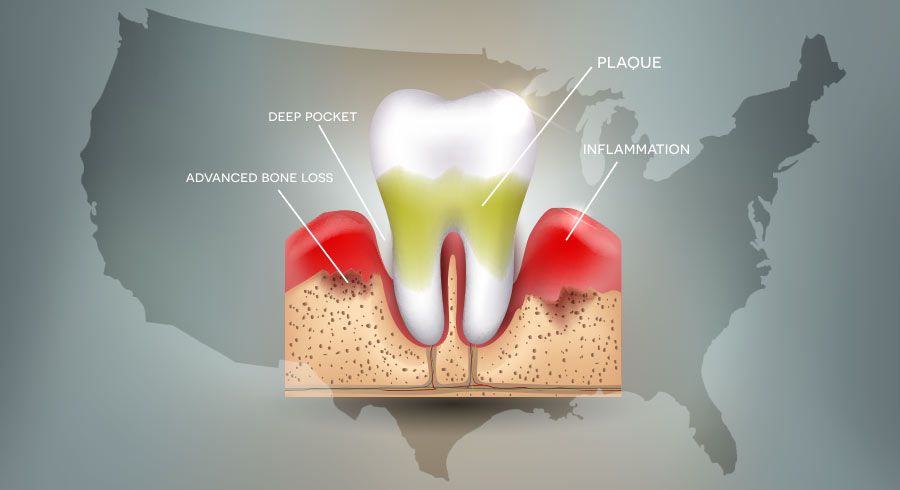 prevalence of gum disease