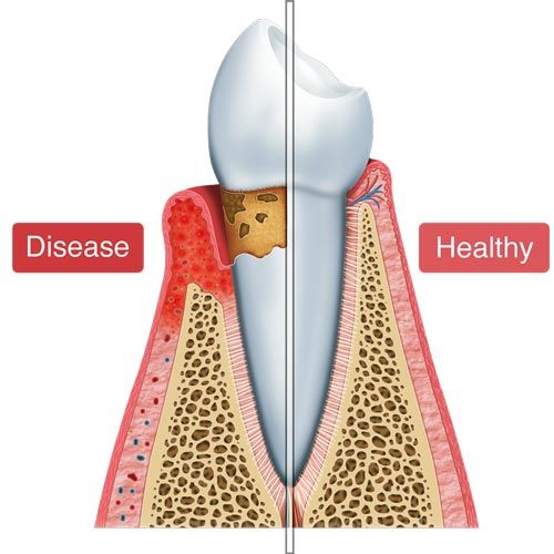 diagram of gum disease