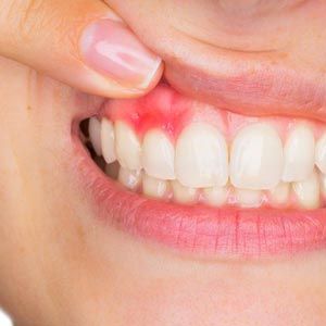 Red, Swollen, Tender Gums