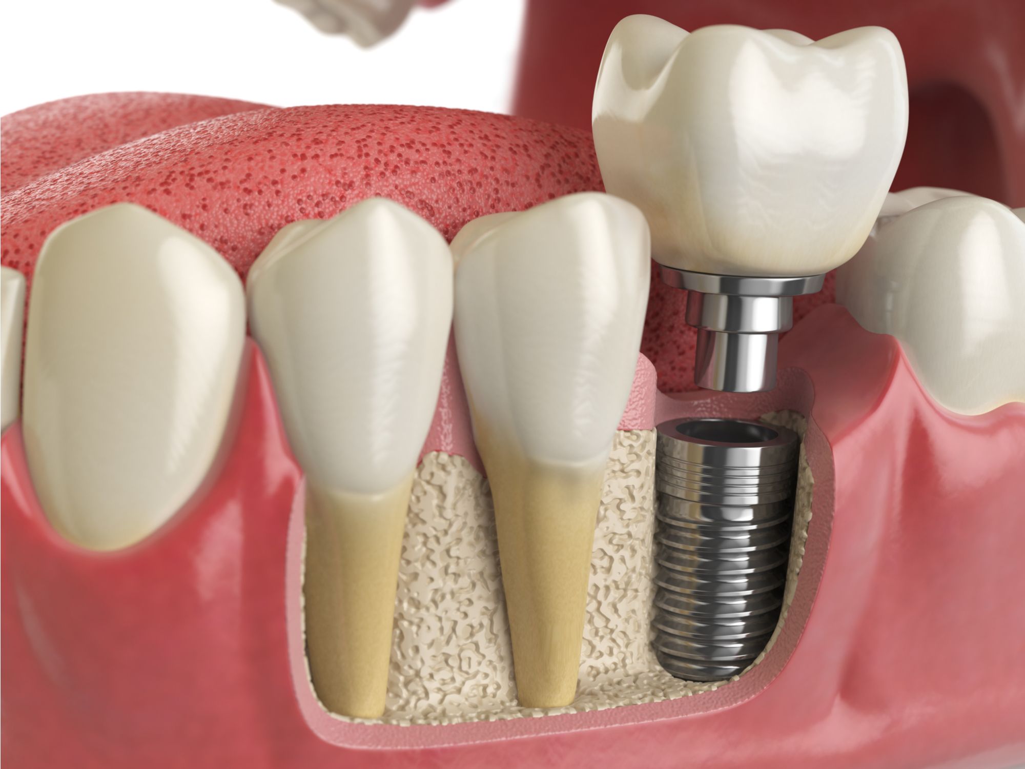dental implant